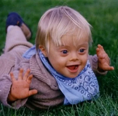 Down-Syndrome-Child-3