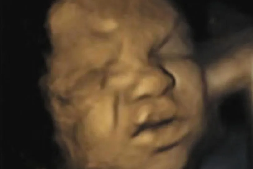 Неродените изпитват болка. Това се вижда по гримасите на лицата им.
