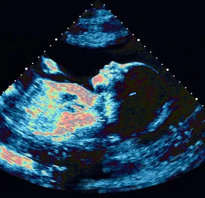 Скенер на бебе в напреднала бременност
