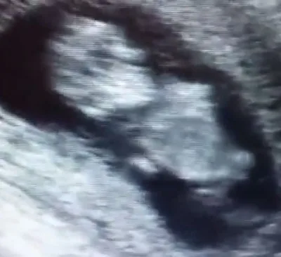 Ултразвук, бебе на 11 седмици и 4 дни